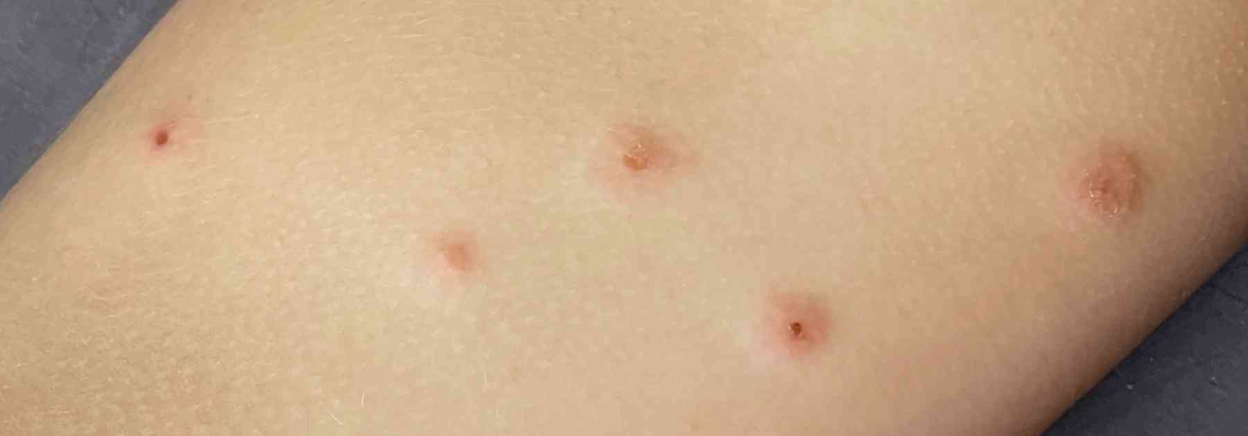 impetigo spots