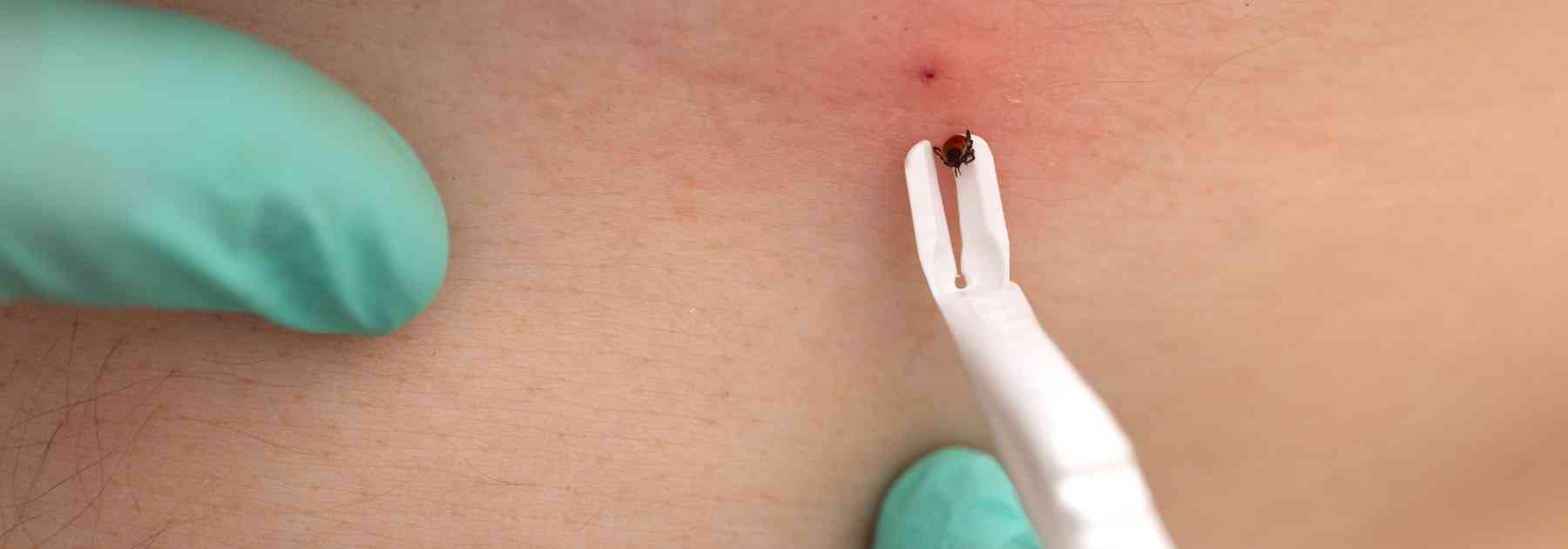 person wearing medical gloves using white tick removal tool