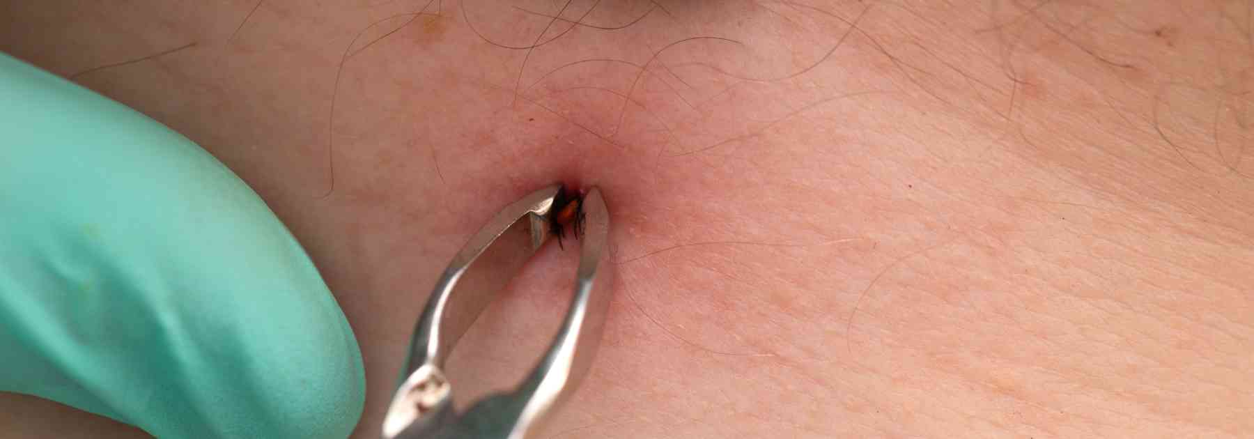 close-up of person using tick removal tool